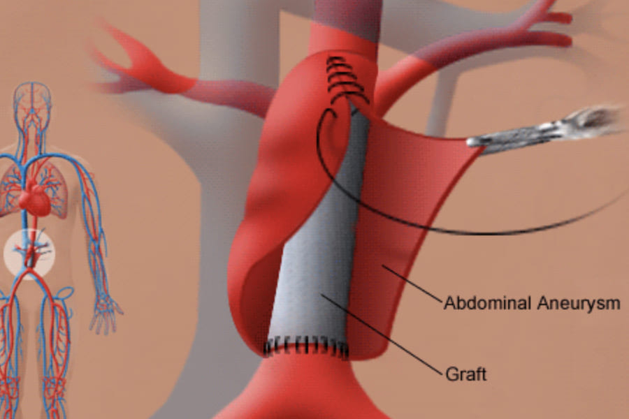 Cirugía Abierta y Endovascular para Aneurismas de Aorta