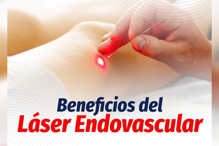 Tratamiento Varices con Metodología Láser y Radiofrecuencia