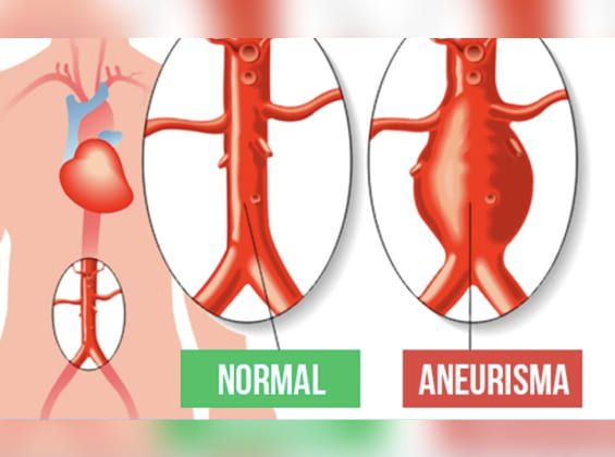 Cirugía Abierta y Endovascular para Aneurismas de Aorta