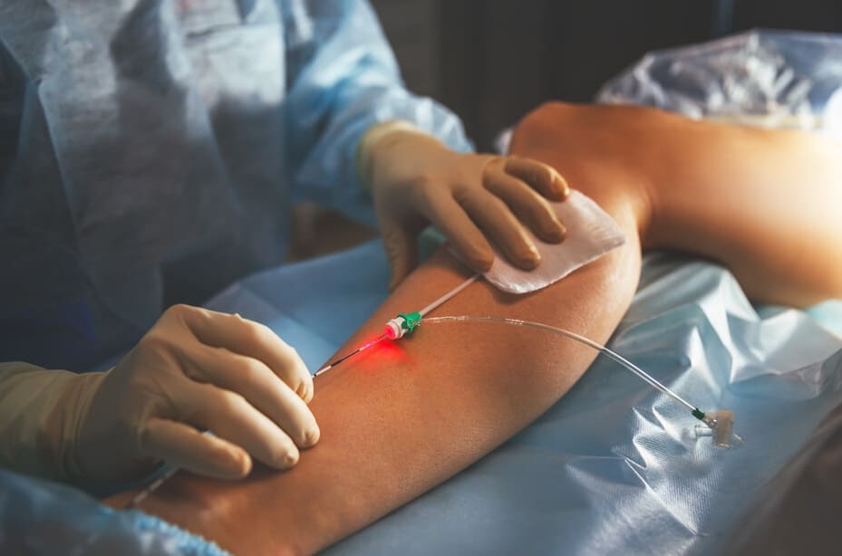 Tratamiento varices con metodología láser Y radiofrecuencia