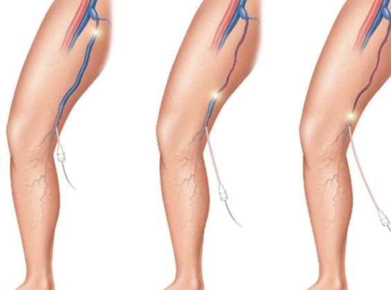 Terapia Endovascular para Trombosis Venosas